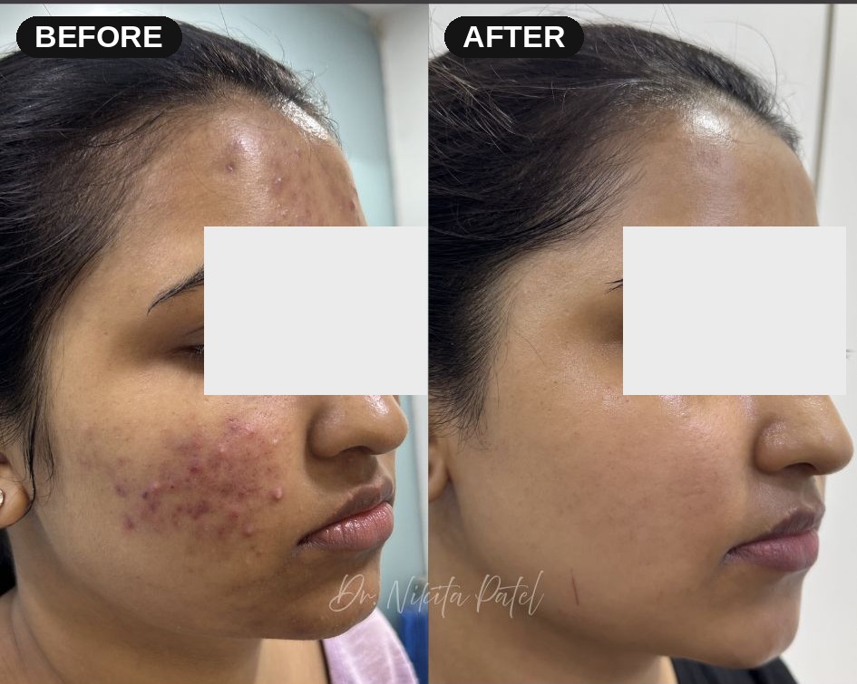 Before and after photos showing improvement in active acne