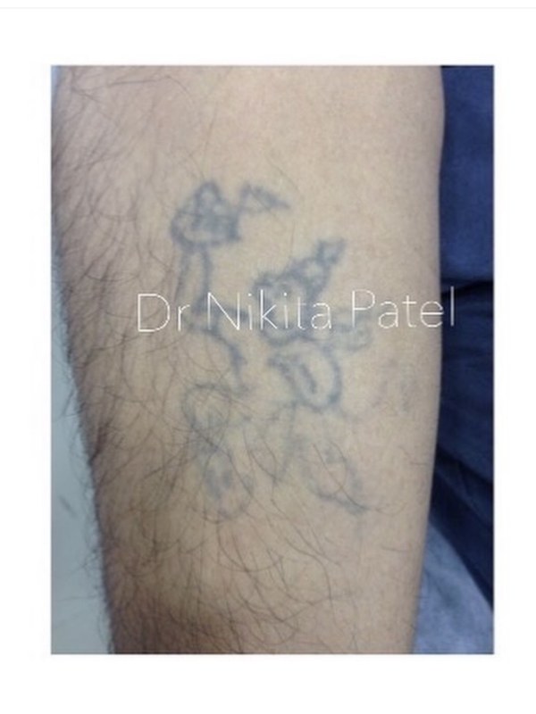 Forearm tattoo before laser removal treatment