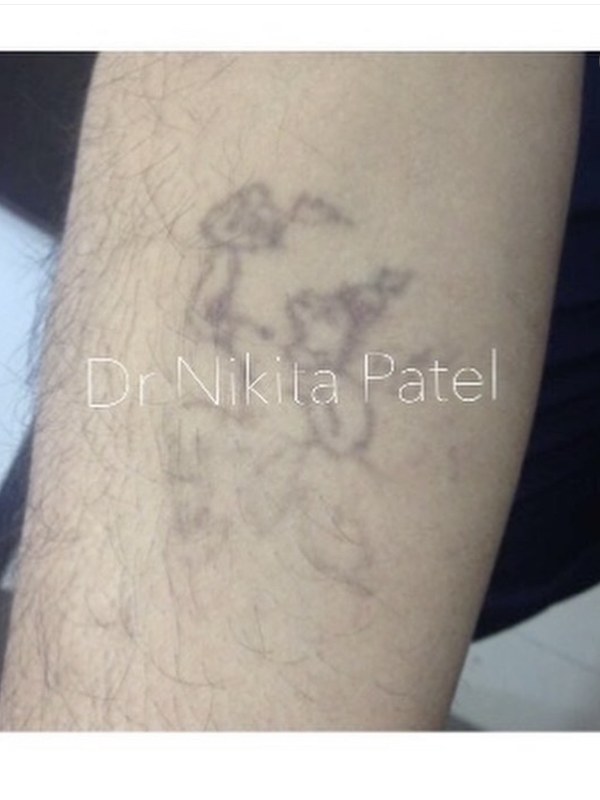 Forearm tattoo fading after early laser removal sessions