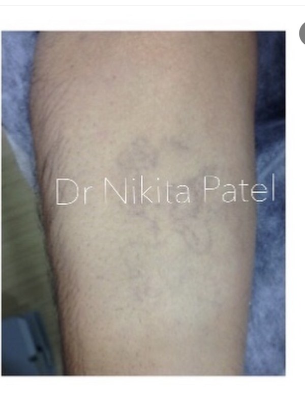 Forearm tattoo further faded after continued laser removal