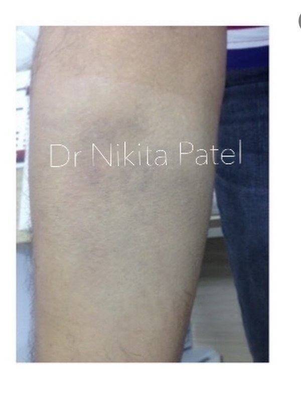 Forearm tattoo nearly cleared after laser removal treatment