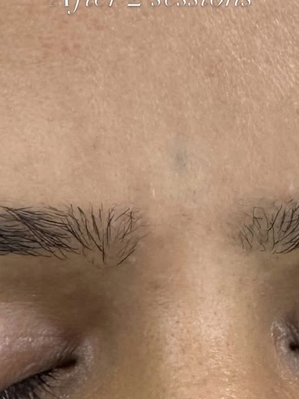 Forehead bindi tattoo faded after two laser removal sessions