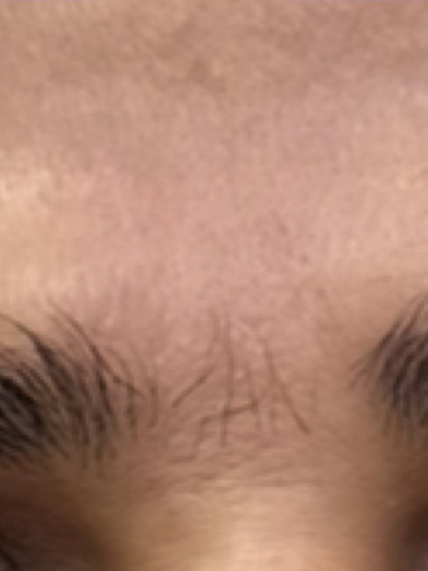 Forehead bindi tattoo cleared after three laser removal sessions