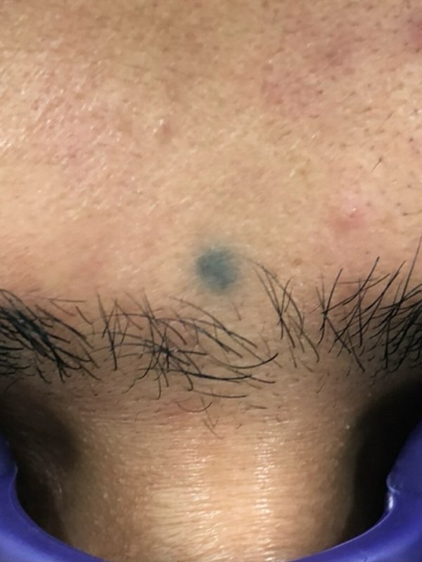 Forehead bindi tattoo before laser removal