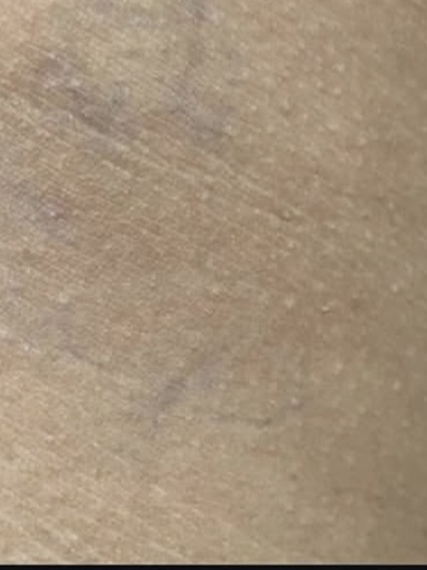 Neck tattoo before laser removal