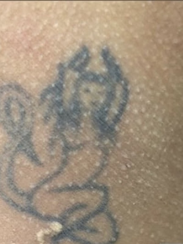 Neck tattoo before laser removal