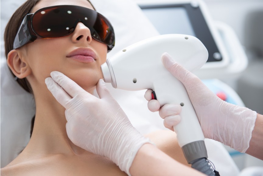 Laser hair removal treatment on a patient's upper lip and chin area at Clear Skin Clinic