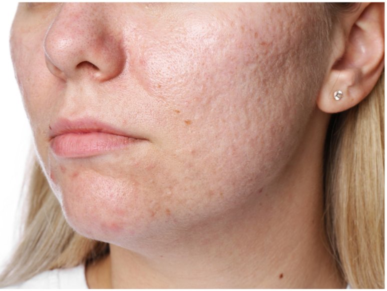 Clear Skin Clinic patient