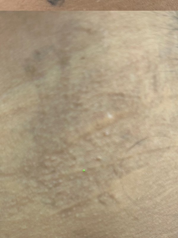 Neck tattoo cleared after laser removal
