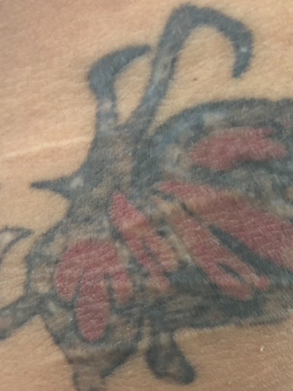 Neck tattoo faded after laser removal
