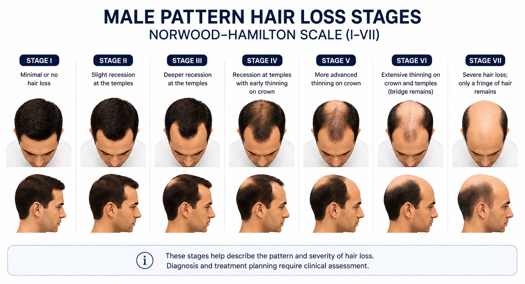 Illustrative diagram of male pattern hair loss stages I through VII on the Norwood–Hamilton scale, showing progressive temple recession and crown thinning
