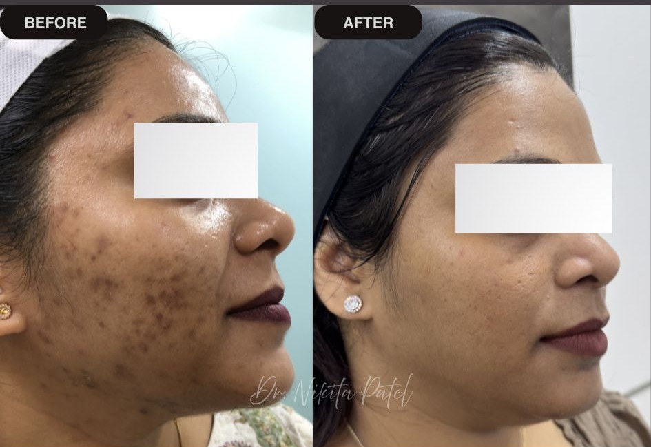 Before and after photos showing visible improvement in acne, pigmentation and scars