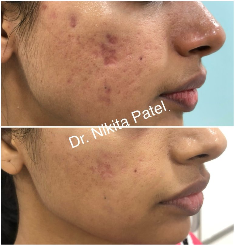 Mixed ice pick and box scar before and after combination treatment