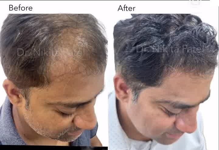 Four-panel before and after photos of a female patient's hairline over 6 months of medical hair-loss treatment