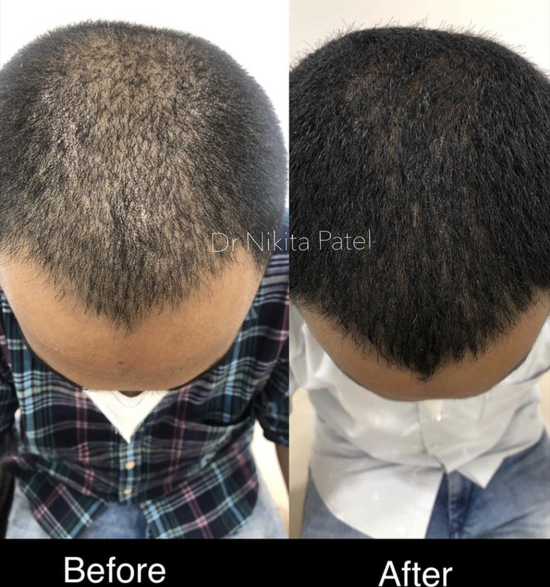 Before and after top-of-scalp photos showing increased hair density after treatment