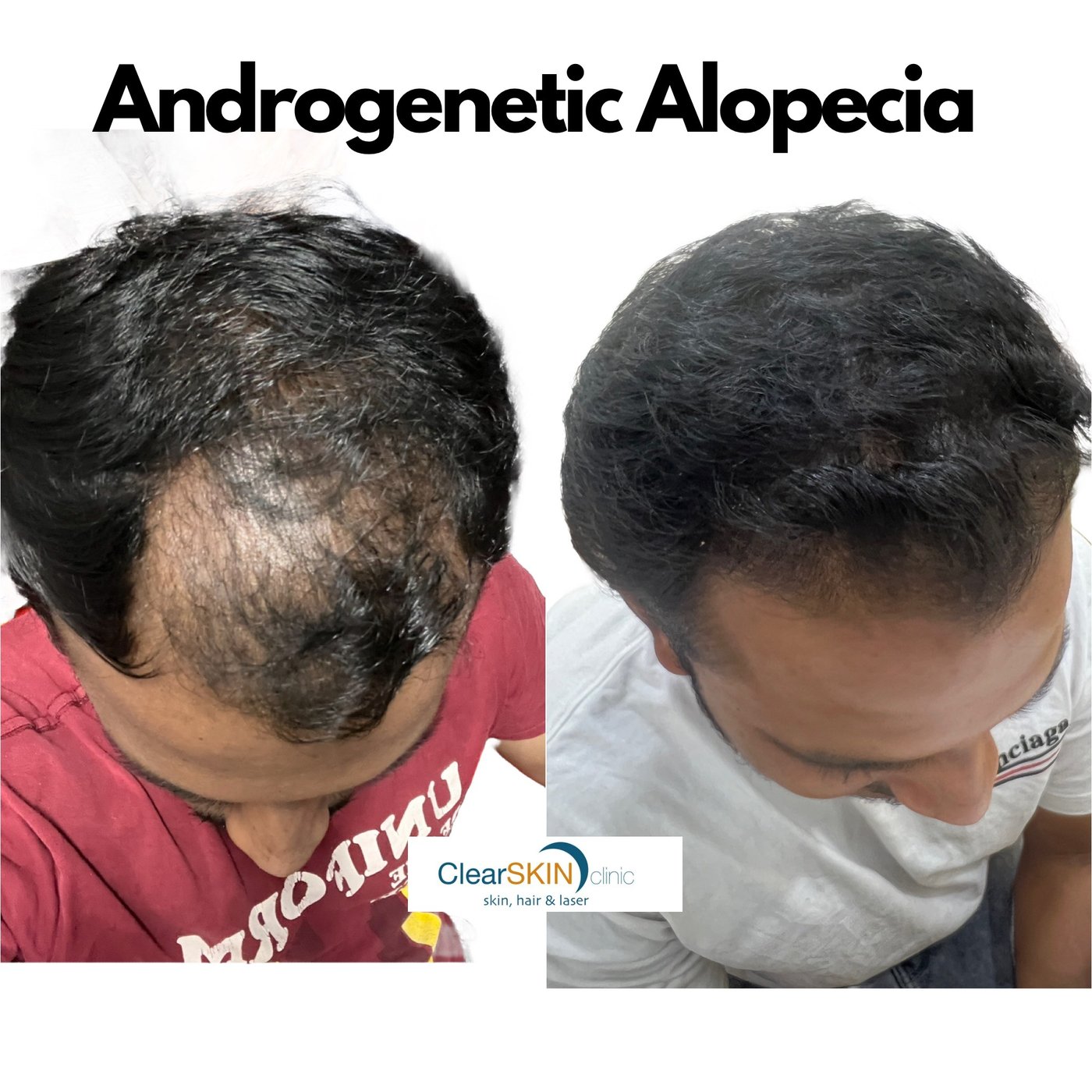 Before and after top-of-scalp photos showing improved hair density after medical therapy for androgenetic alopecia