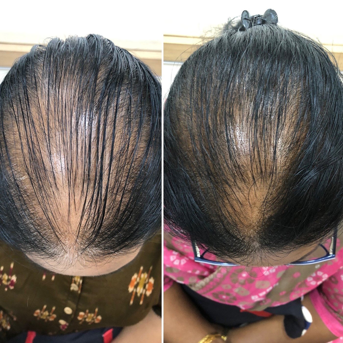 Before and after photos of central hair part showing reduced scalp visibility after treatment