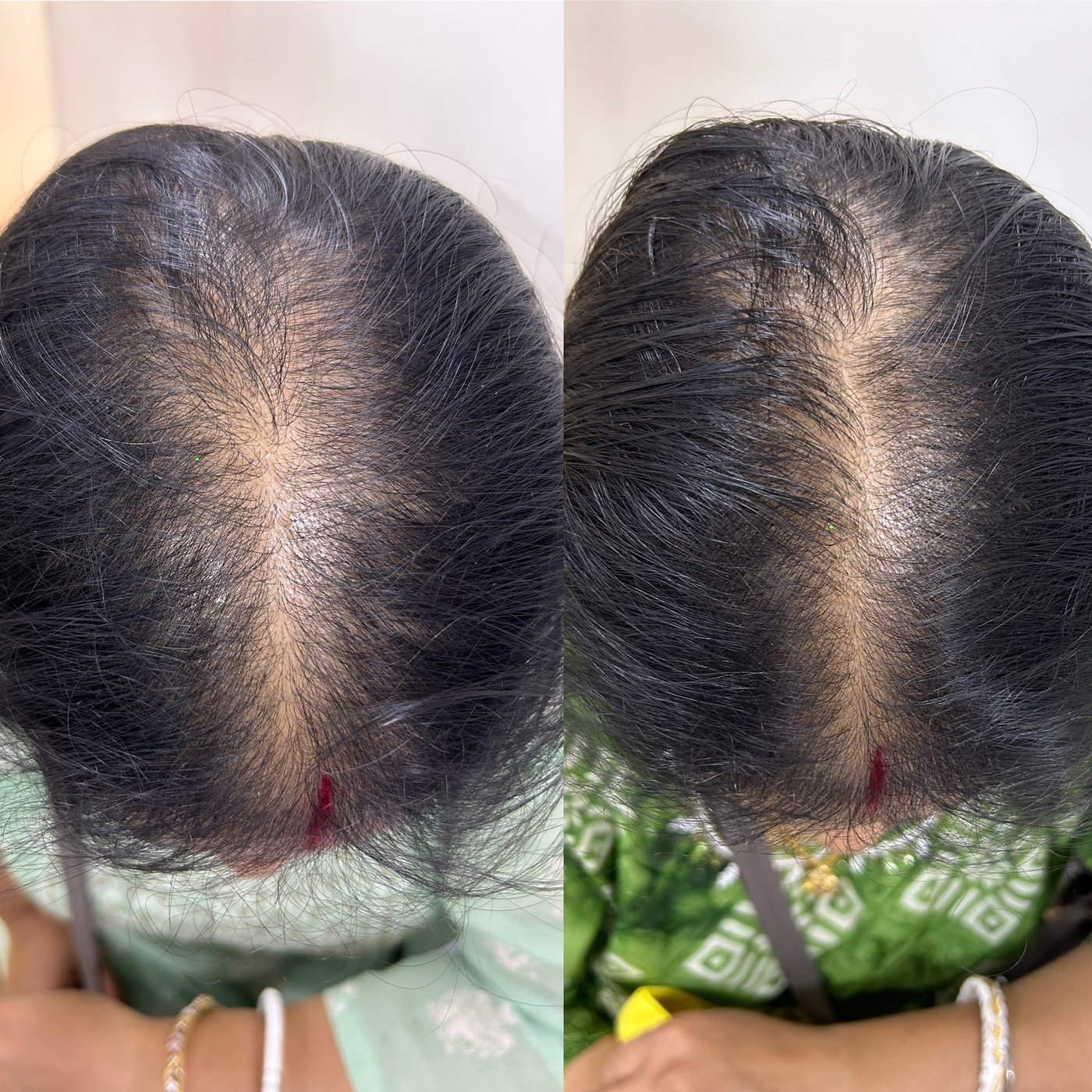 Before and after top-of-scalp photos showing improved central density after treatment