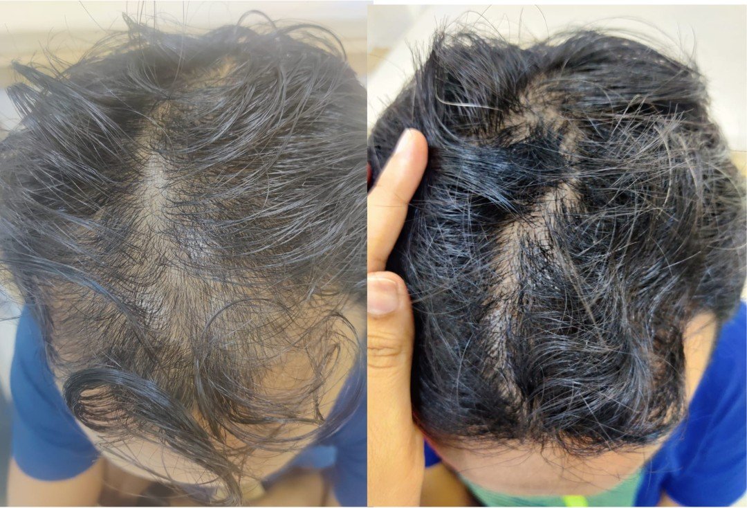 Before and after angled scalp photos showing improved hairline density after treatment