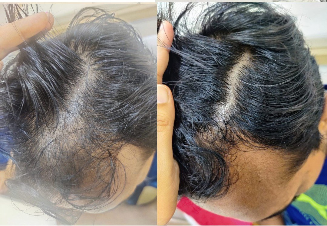 Before and after photos of central hair part showing improved density after treatment