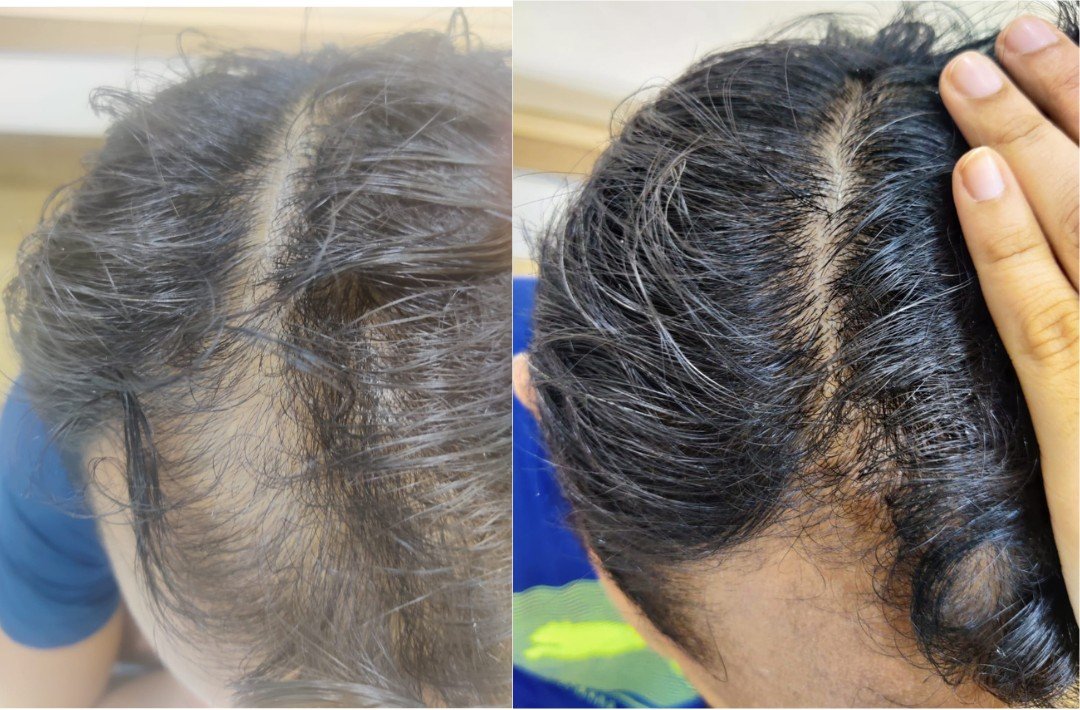 Before and after top-of-scalp photos showing reduced central part visibility after treatment