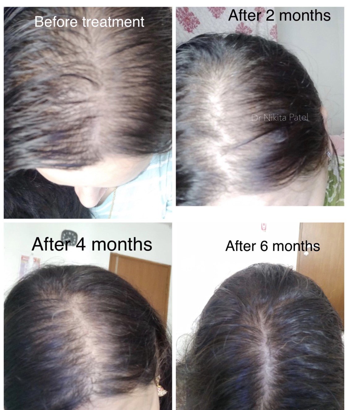 Before and after top-of-scalp photos showing improved hair density after treatment