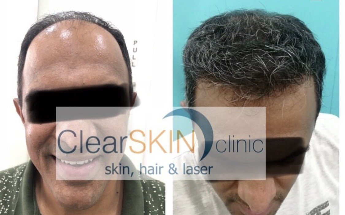 Before and after front-facing photos of an FUE hair transplant patient showing restored frontal hairline