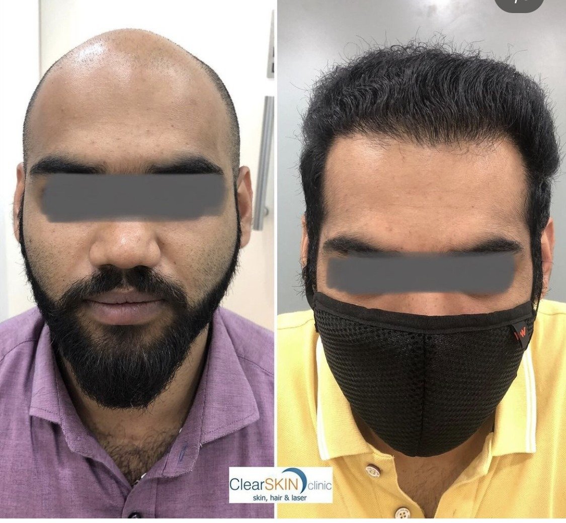 Before and after front-facing photos of a hair transplant patient showing restored hairline density