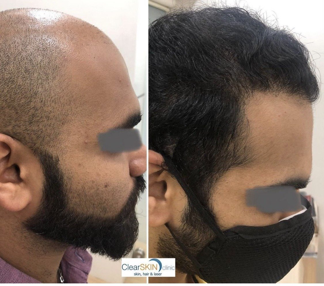 Before and after side-profile photos of a hair transplant patient showing restored hairline