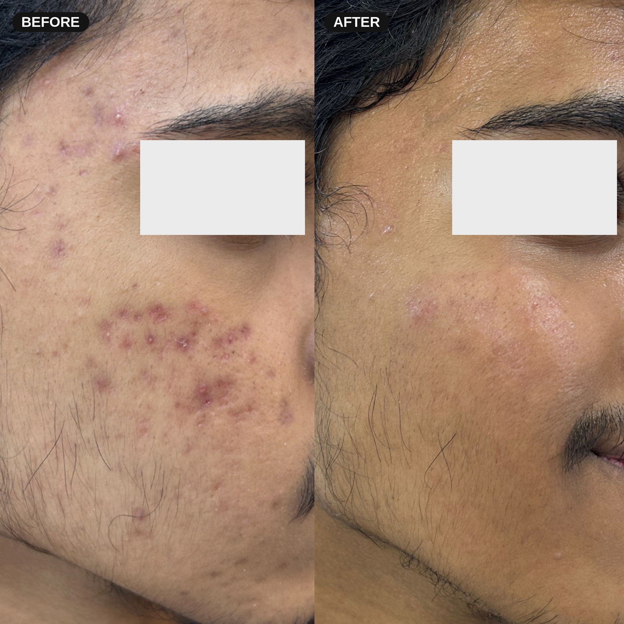 Before and after photos showing improvement in acne scars and texture