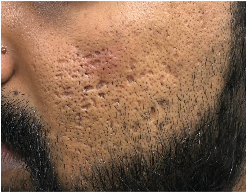 Ice pick and deep box scar patient photo