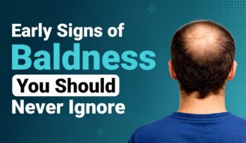 Early Signs of Baldness You Should Never Ignore
