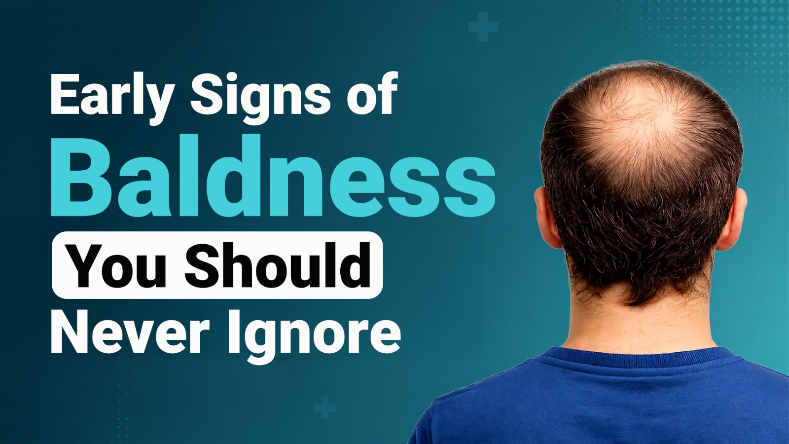 Early Signs of Baldness You Should Never Ignore