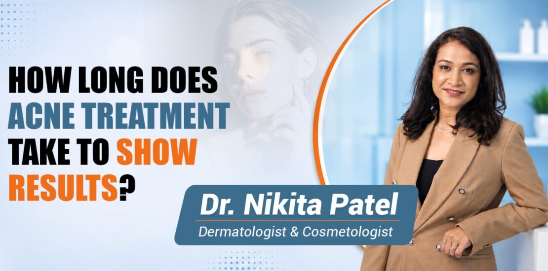 How Long Does Acne Treatment Take to Show Results?