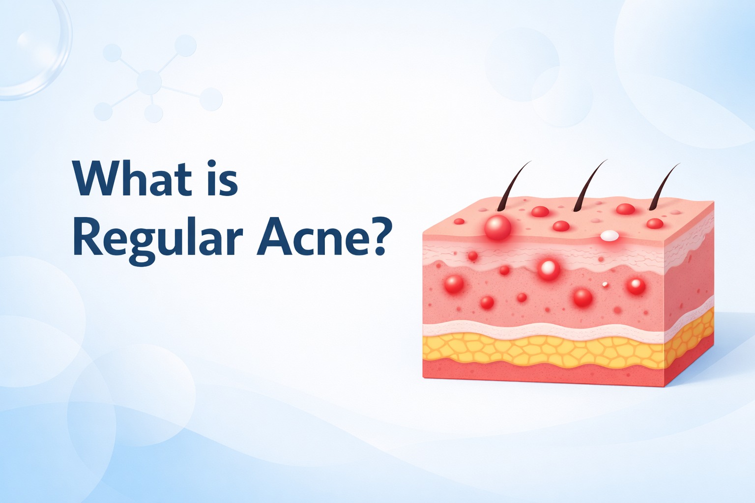 Acne vs Hormonal Acne