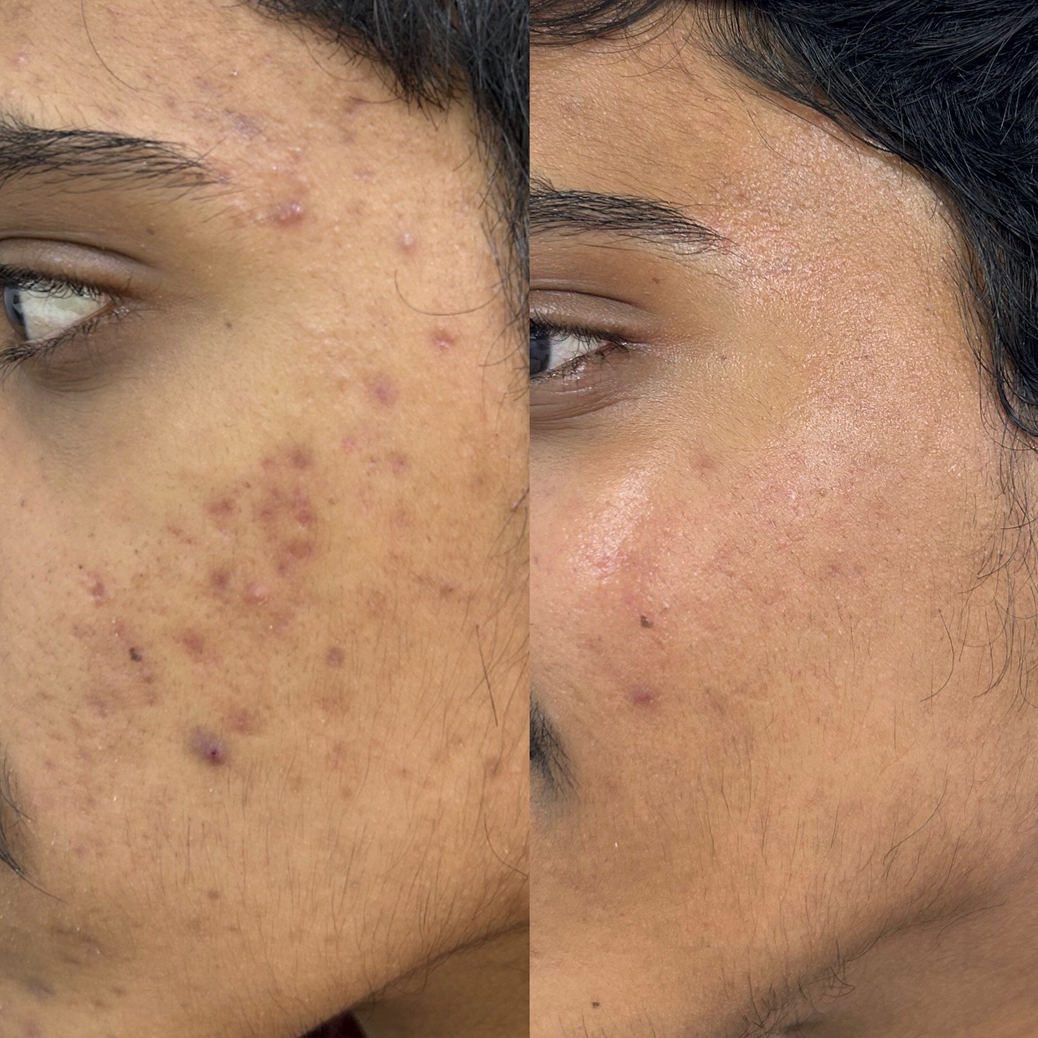 Box scar before and after Microneedling Radiofrequency and laser resurfacing