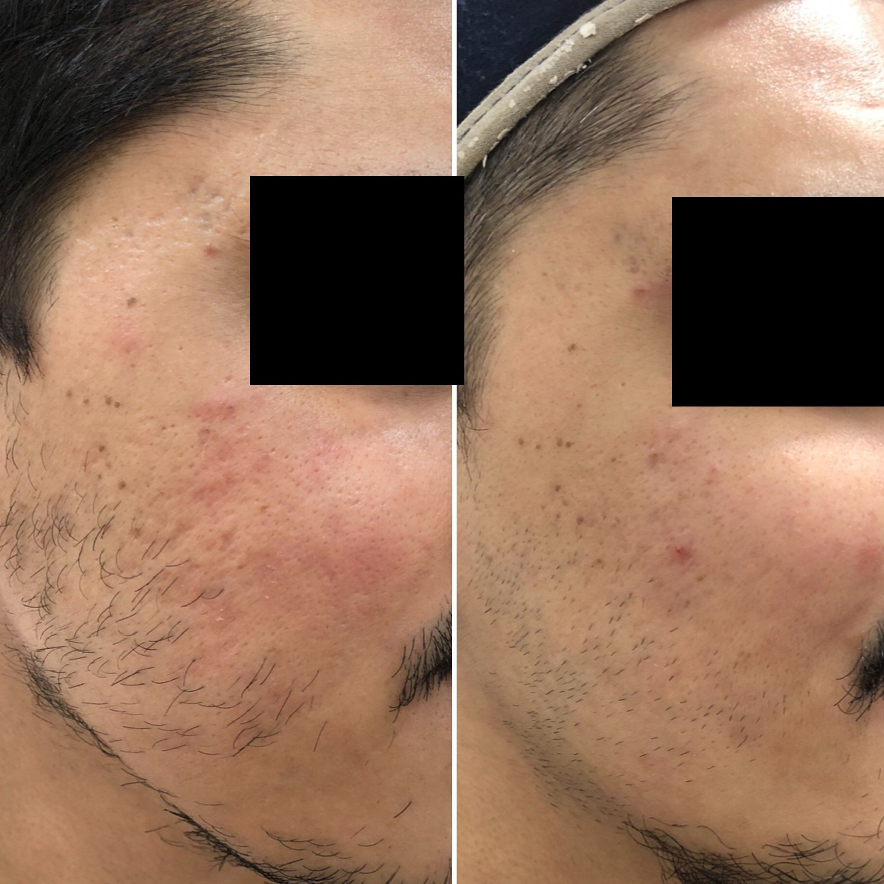 Box scar before and after Microneedling Radiofrequency