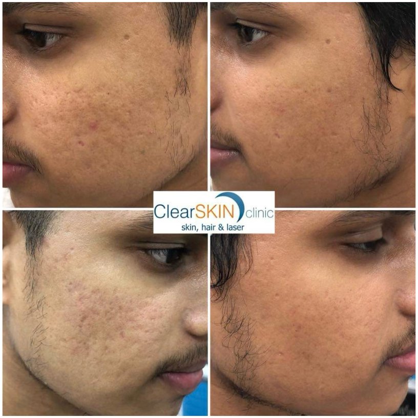 Deep box scar before and after MNRF