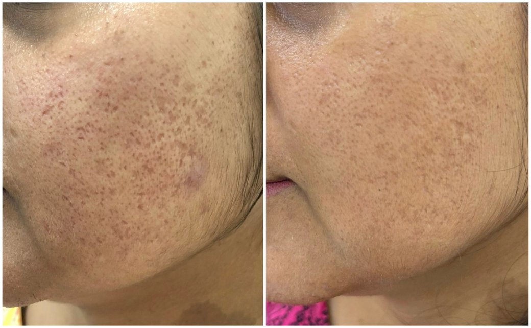 Ice pick and box scar before and after treatment