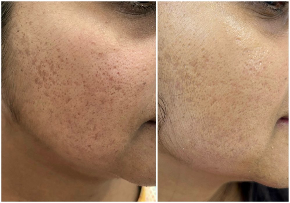 Ice pick and box scar before and after treatment
