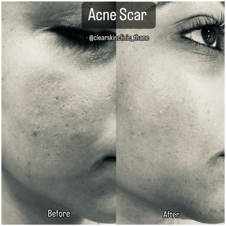 Deep box scar before and after subcision, MNRF and PRP