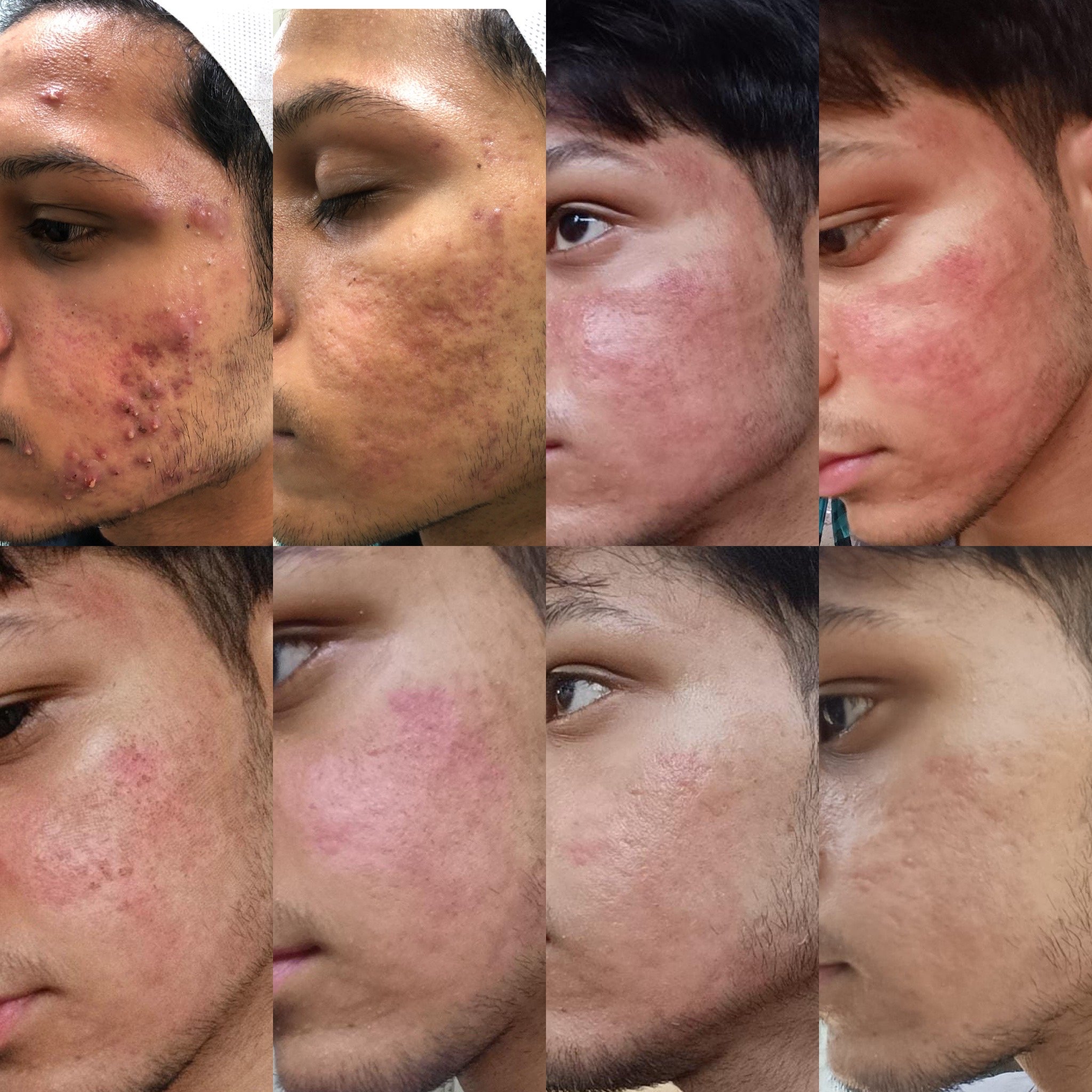Four patients before and after a single session of laser resurfacing