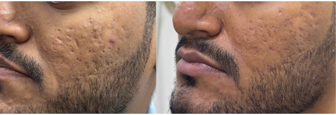 Mixed ice pick and box scar before and after combination treatment, profile view