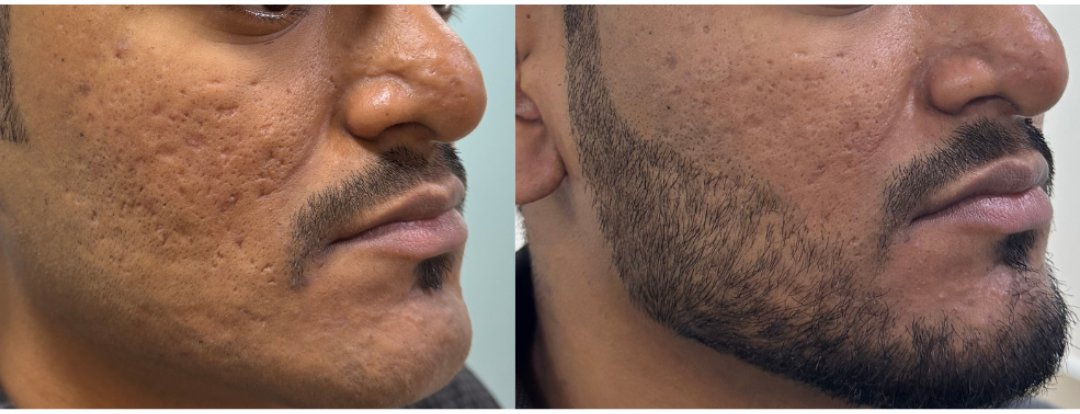 Ice pick scar before and after single session TCA CROSS with MNRF