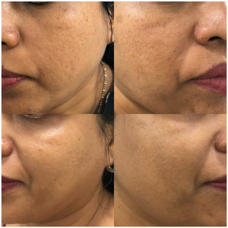 Open pores and skin laxity before and after MNRF