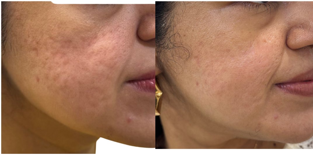 Rolling scar before and after subcision