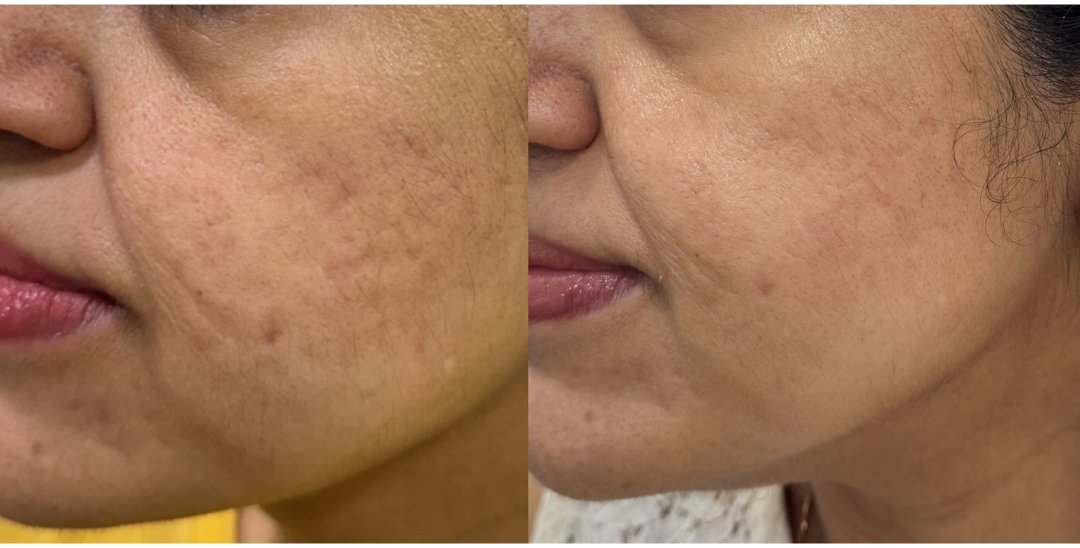 Rolling scar before and after subcision
