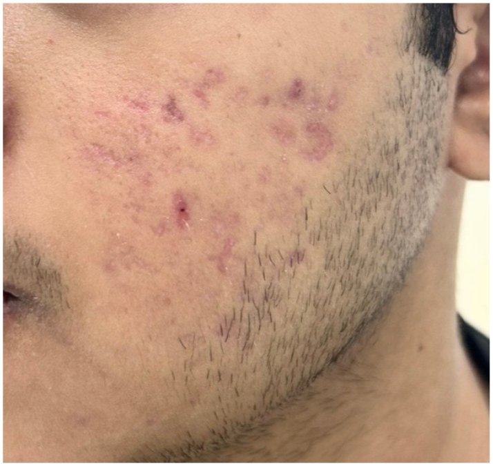Boxcar scar patient photo