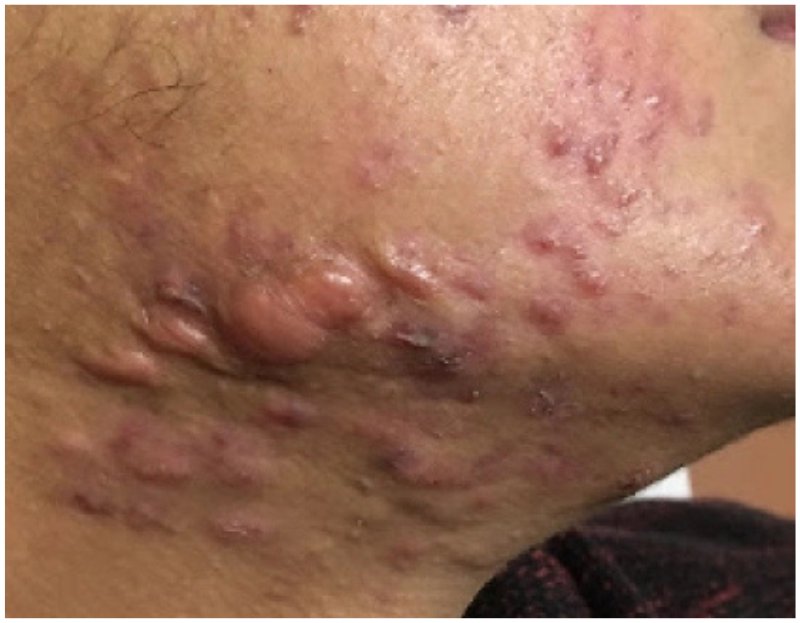 Keloid scar patient photo