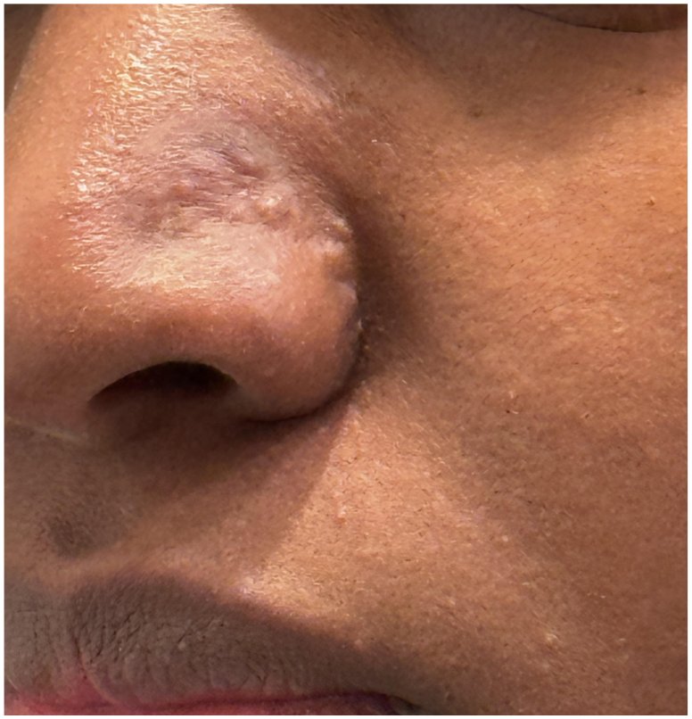 Papular scar patient photo